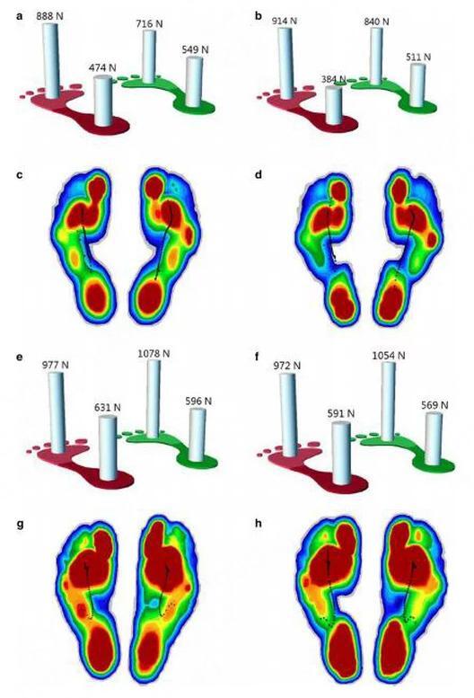 Plantar Pressure Analysis